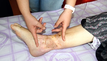 Deri Nakli Ameliyatı ve Riskleri Deri Nakli Ameliyatı ve Riskleri