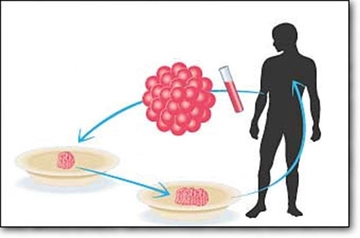 Otolog Kök Hücre Nakli Ameliyatı ve Riskleri Otolog Kök Hücre Nakli Ameliyatı ve Riskleri